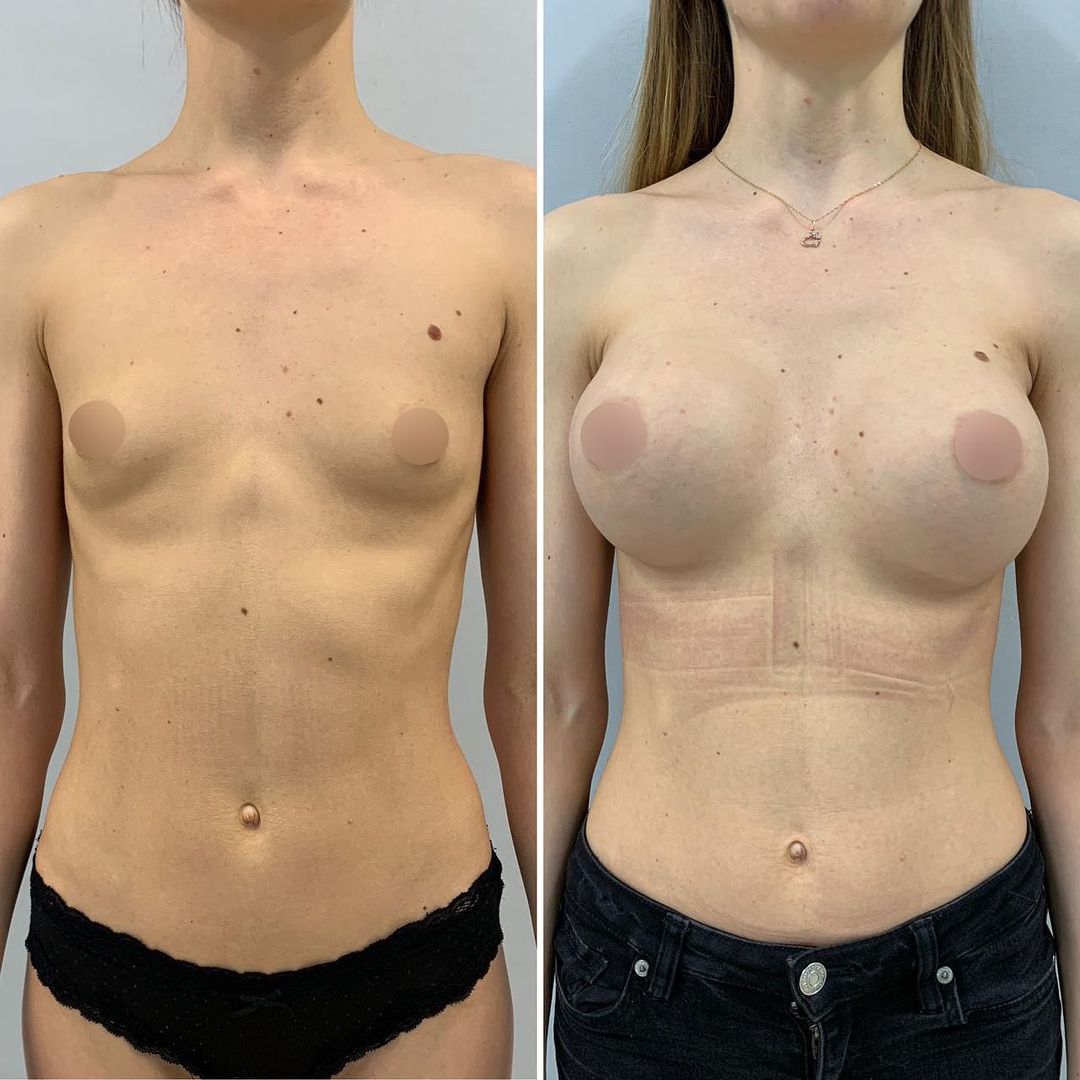 До и после увеличения груди Косинец