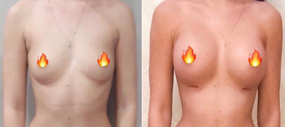 До и после пластики груди