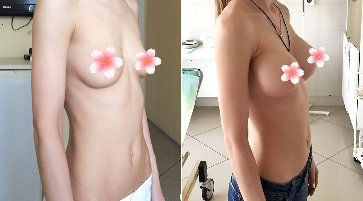 До и после увеличения груди Косинец