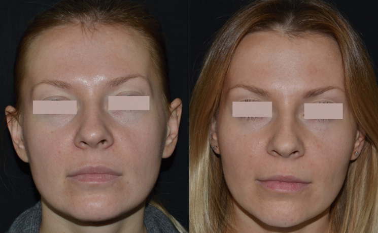 До и после липофилинга лица