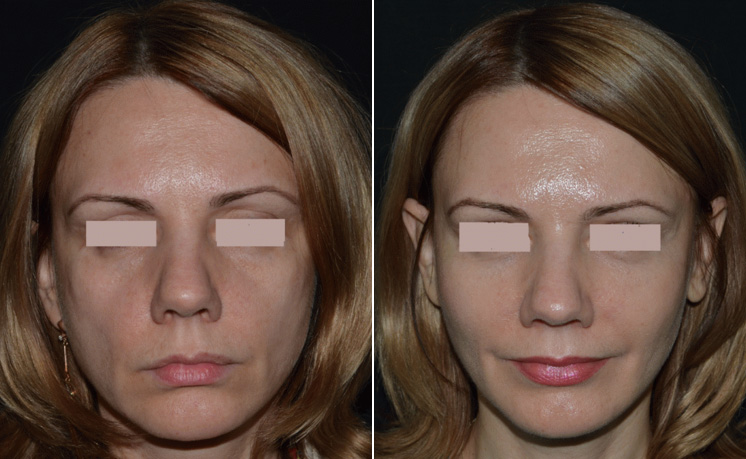 До и после липофилинга лица