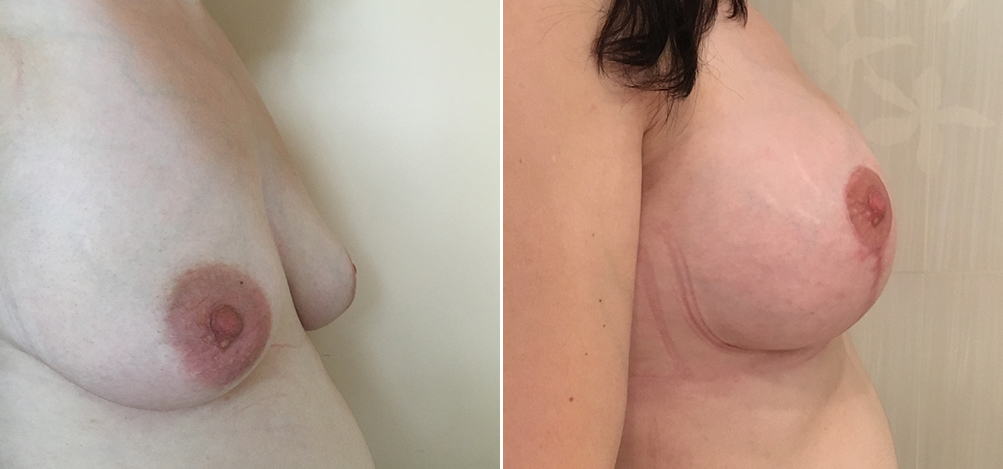 До и после пластики груди